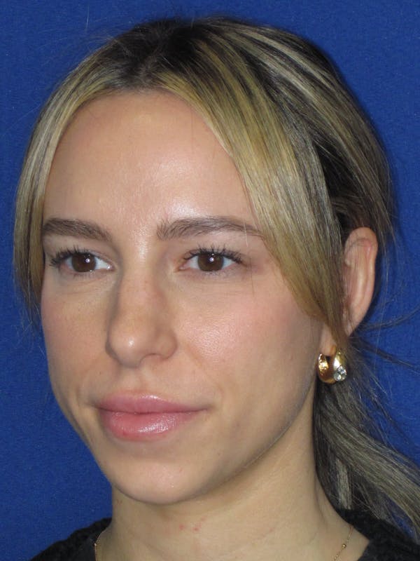 Rhinoplasty Before & After Gallery - Patient 257950 - Image 7