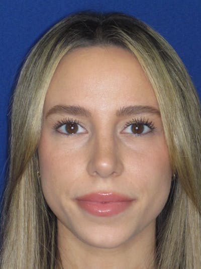 Rhinoplasty Before & After Gallery - Patient 257950 - Image 4