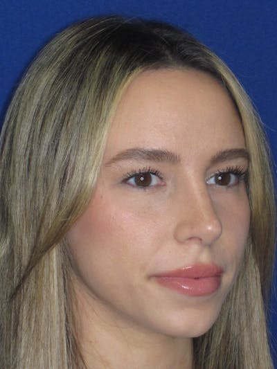 Rhinoplasty Before & After Gallery - Patient 257950 - Image 2