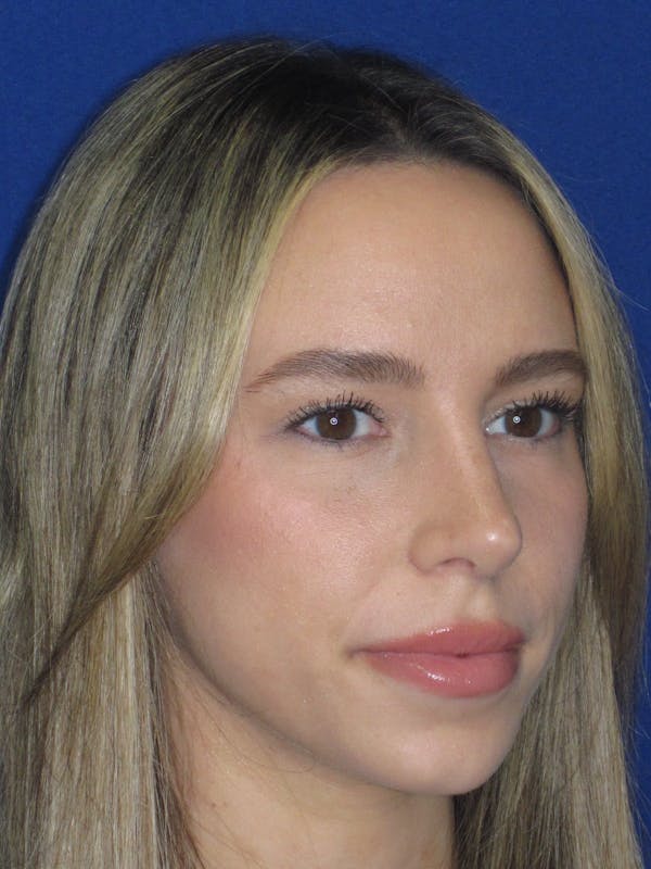 Rhinoplasty Before & After Gallery - Patient 257950 - Image 2