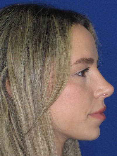 Rhinoplasty Before & After Gallery - Patient 257950 - Image 6