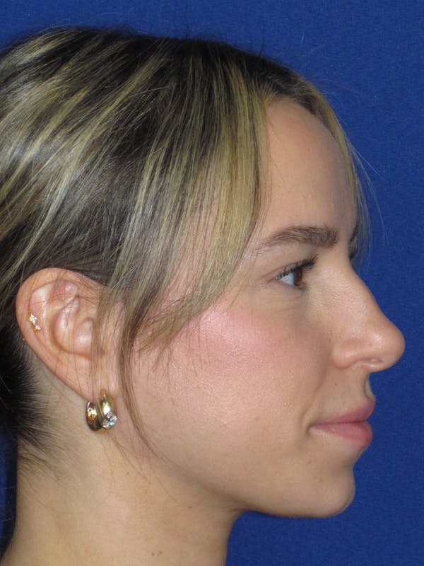 Rhinoplasty Before & After Gallery - Patient 257950 - Image 5