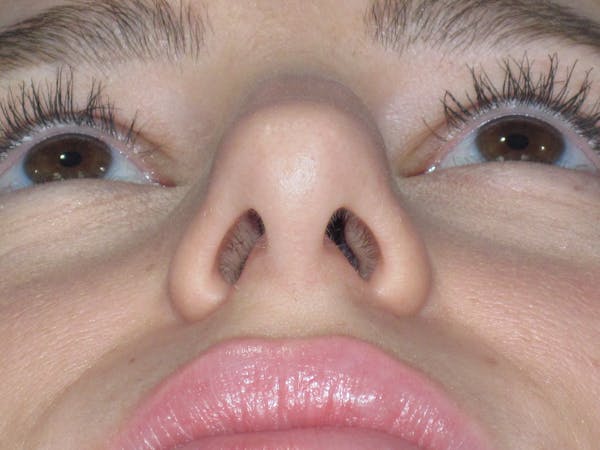 Rhinoplasty Before & After Gallery - Patient 257950 - Image 9