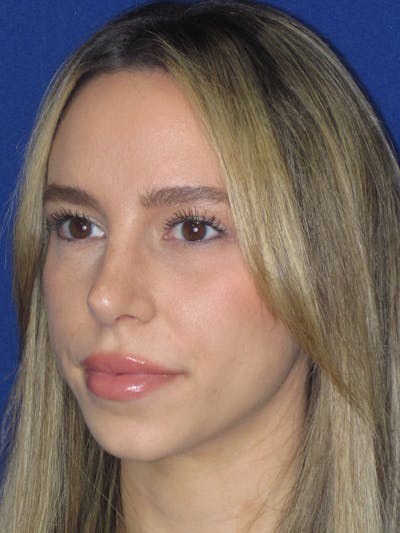 Rhinoplasty Before & After Gallery - Patient 257950 - Image 8