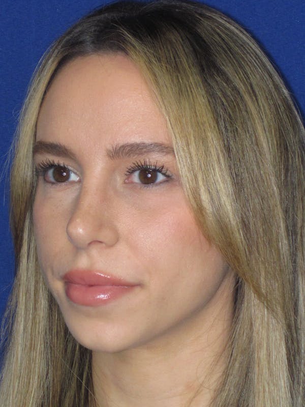 Rhinoplasty Before & After Gallery - Patient 257950 - Image 8