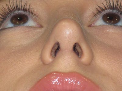 Rhinoplasty Before & After Gallery - Patient 257950 - Image 10