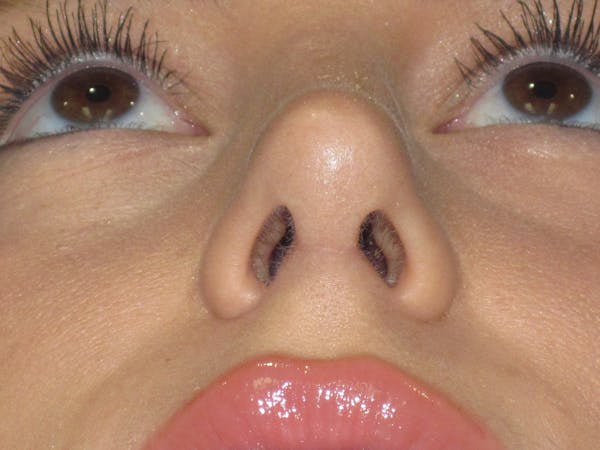 Rhinoplasty Before & After Gallery - Patient 257950 - Image 10