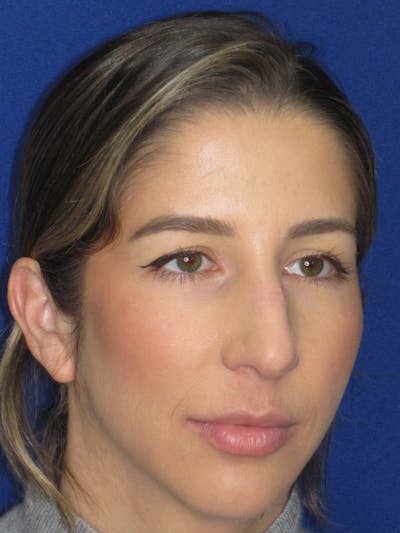 Rhinoplasty Before & After Gallery - Patient 157124 - Image 2