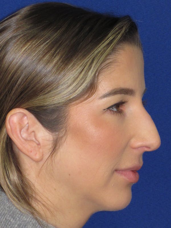 Rhinoplasty Before & After Gallery - Patient 157124 - Image 3