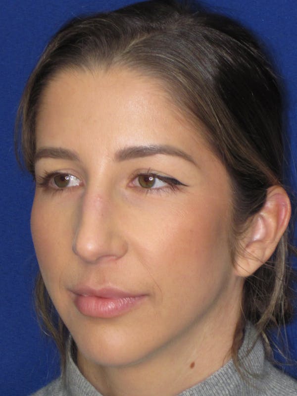 Rhinoplasty Before & After Gallery - Patient 157124 - Image 7