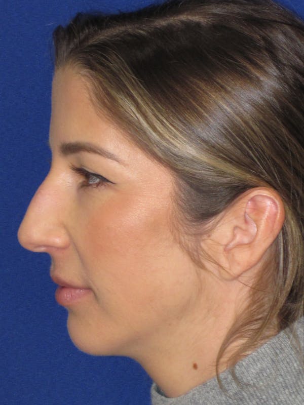 Rhinoplasty Before & After Gallery - Patient 157124 - Image 9