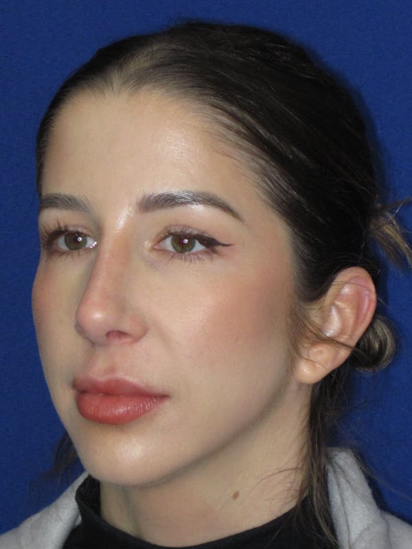 Rhinoplasty Before & After Gallery - Patient 157124 - Image 8