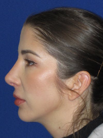 Rhinoplasty Before & After Gallery - Patient 157124 - Image 10