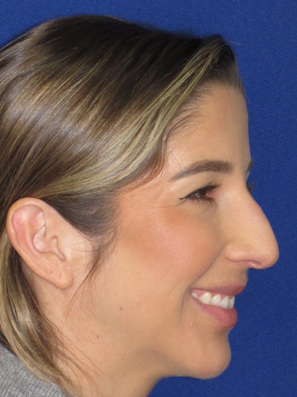 Rhinoplasty Before & After Gallery - Patient 157124 - Image 5