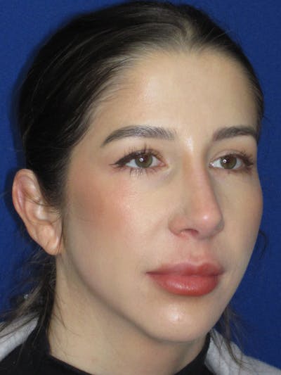 Rhinoplasty Before & After Gallery - Patient 157124 - Image 1