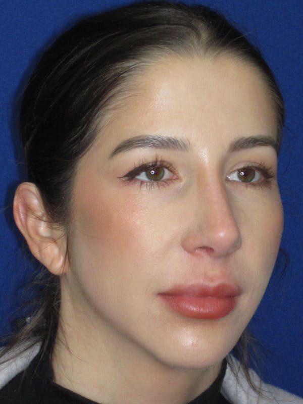 Rhinoplasty Before & After Gallery - Patient 157124 - Image 1