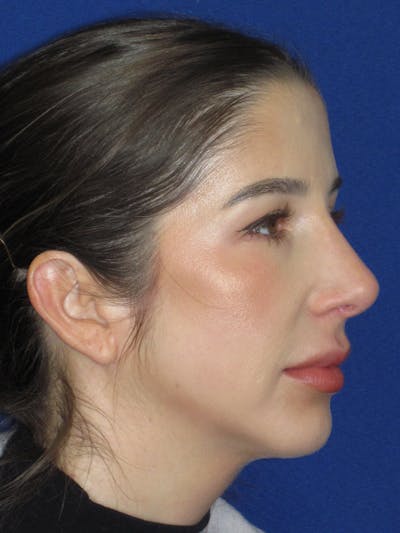 Rhinoplasty Before & After Gallery - Patient 157124 - Image 4