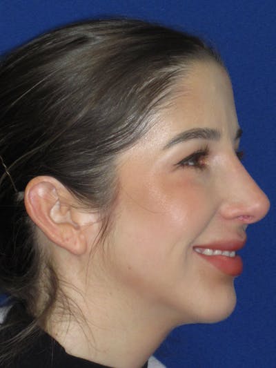 Rhinoplasty Before & After Gallery - Patient 157124 - Image 6