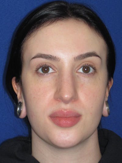 Rhinoplasty Before & After Gallery - Patient 647173 - Image 1