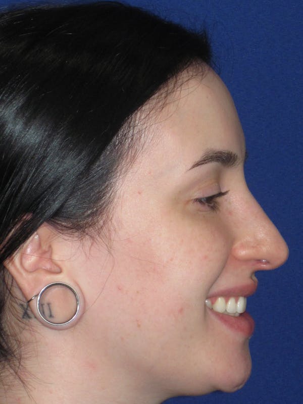 Rhinoplasty Before & After Gallery - Patient 647173 - Image 7