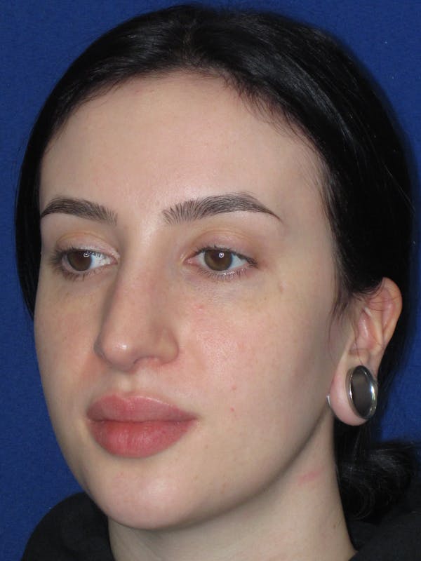 Rhinoplasty Before & After Gallery - Patient 647173 - Image 9