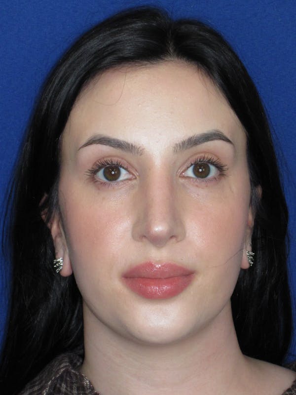 Rhinoplasty Before & After Gallery - Patient 647173 - Image 2