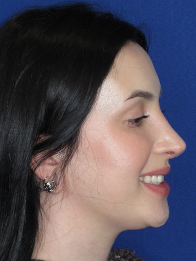 Rhinoplasty Before & After Gallery - Patient 647173 - Image 8