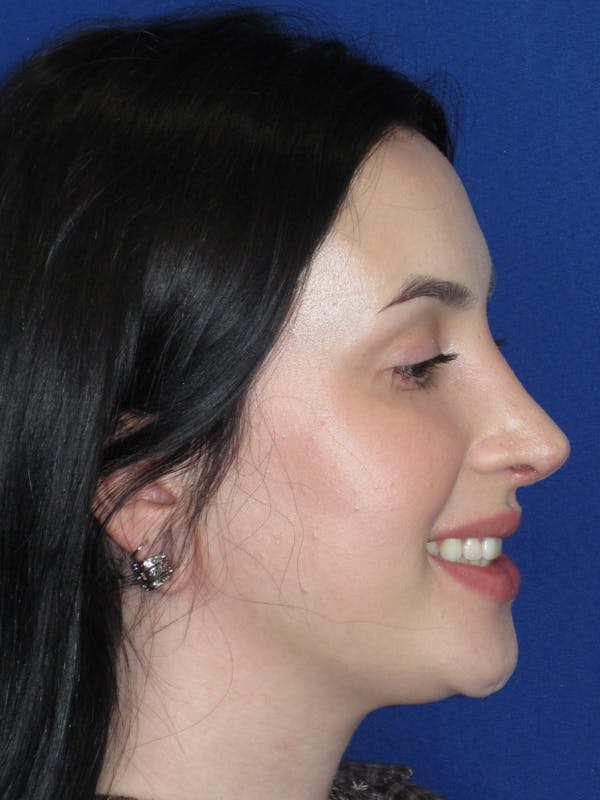 Rhinoplasty Before & After Gallery - Patient 647173 - Image 8