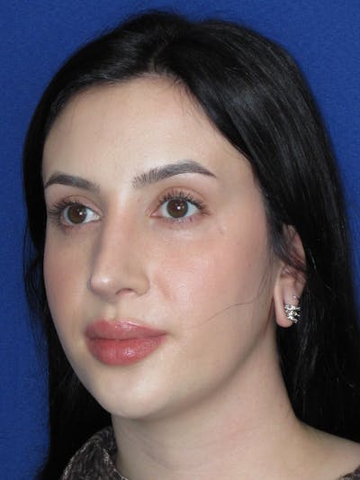 Rhinoplasty Before & After Gallery - Patient 647173 - Image 10