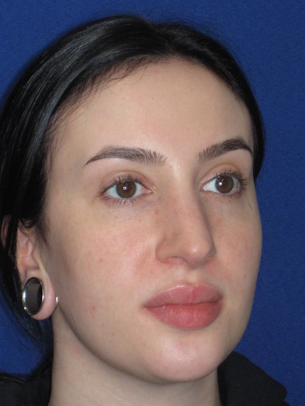 Rhinoplasty Before & After Gallery - Patient 647173 - Image 3