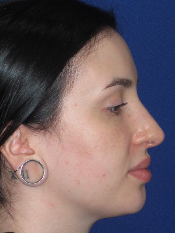 Rhinoplasty Before & After Gallery - Patient 647173 - Image 5