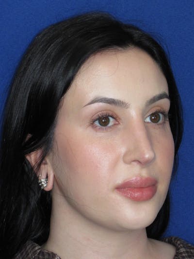 Rhinoplasty Before & After Gallery - Patient 647173 - Image 4