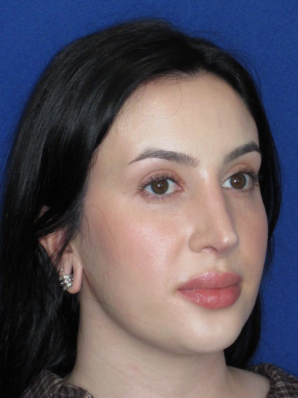 Rhinoplasty Before & After Gallery - Patient 647173 - Image 4