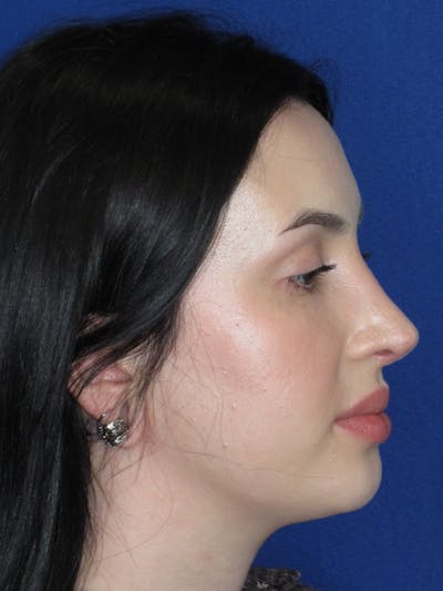 Rhinoplasty Before & After Gallery - Patient 647173 - Image 6