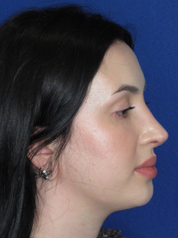 Rhinoplasty Before & After Gallery - Patient 647173 - Image 6