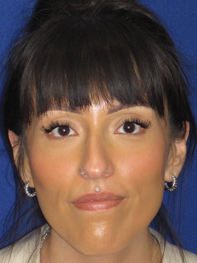 Rhinoplasty Before & After Gallery - Patient 113838 - Image 1