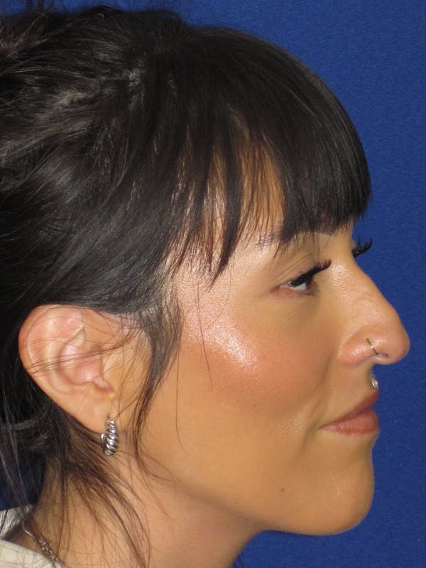 Rhinoplasty Before & After Gallery - Patient 113838 - Image 5