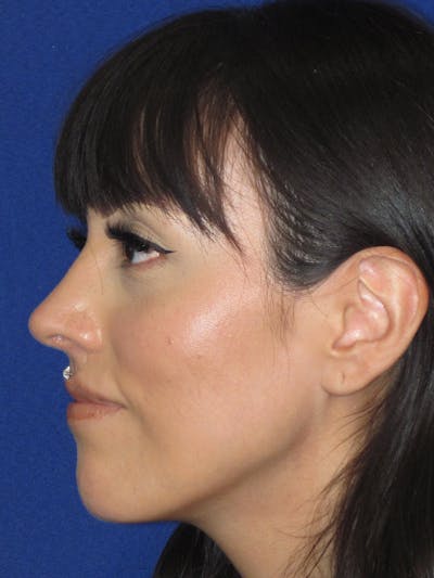 Rhinoplasty Before & After Gallery - Patient 113838 - Image 10