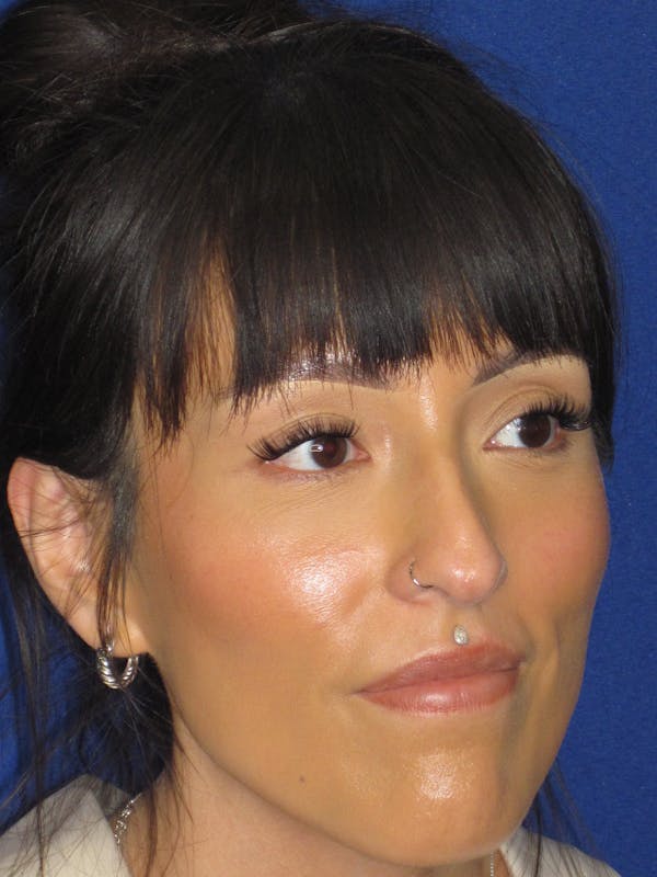 Rhinoplasty Before & After Gallery - Patient 113838 - Image 3