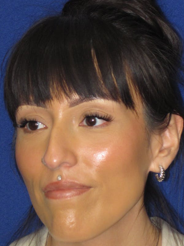 Rhinoplasty Before & After Gallery - Patient 113838 - Image 7