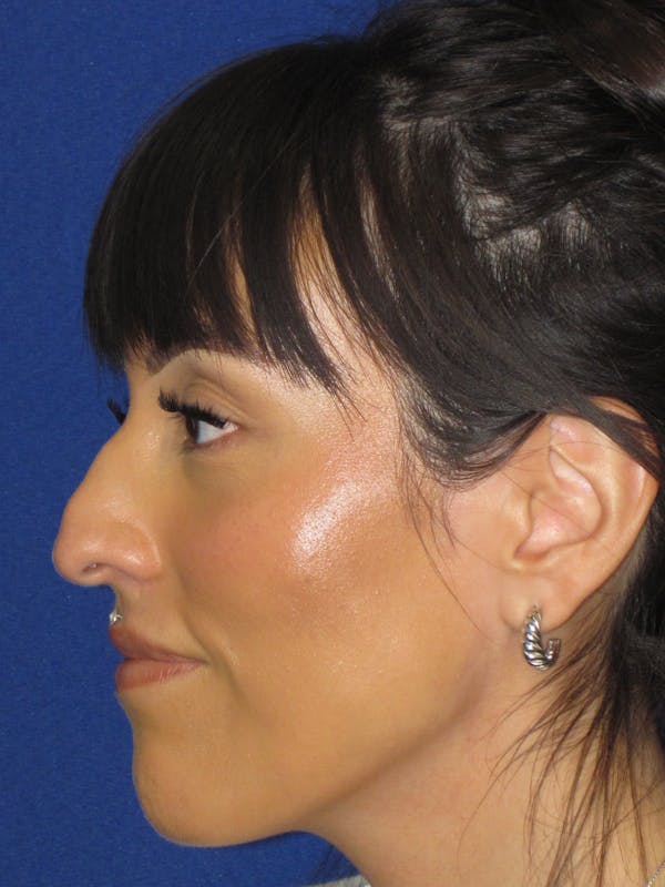 Rhinoplasty Before & After Gallery - Patient 113838 - Image 9