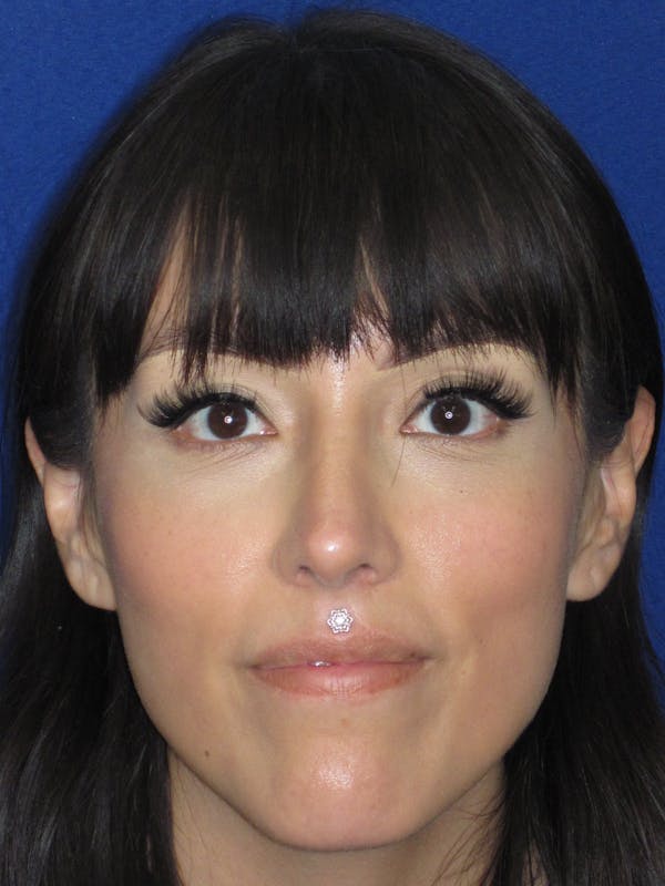 Rhinoplasty Before & After Gallery - Patient 113838 - Image 2