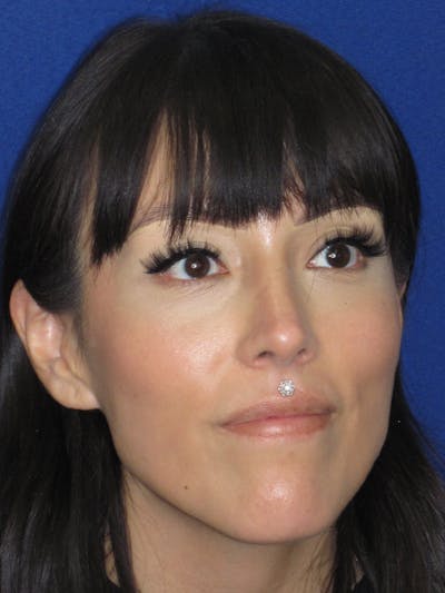 Rhinoplasty Before & After Gallery - Patient 113838 - Image 4