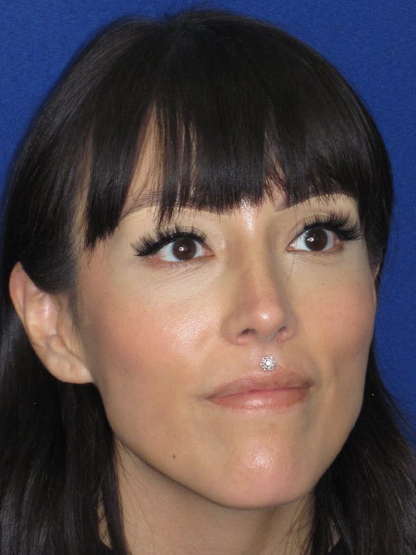 Rhinoplasty Before & After Gallery - Patient 113838 - Image 4