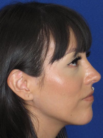 Rhinoplasty Before & After Gallery - Patient 113838 - Image 6