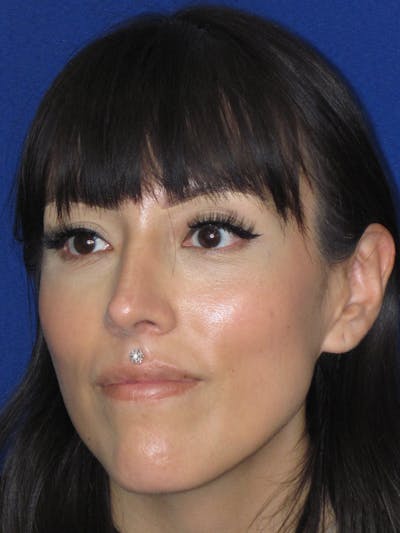 Rhinoplasty Before & After Gallery - Patient 113838 - Image 8