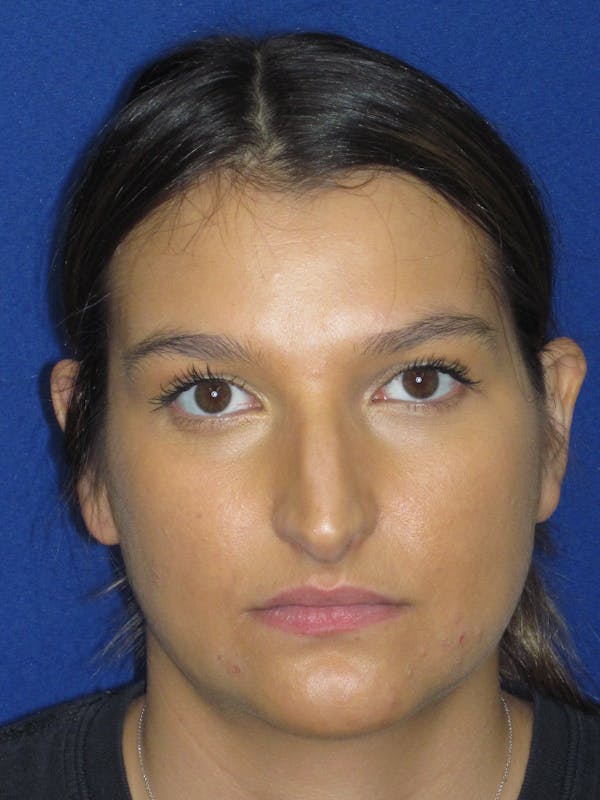 Rhinoplasty Before & After Gallery - Patient 335222 - Image 3