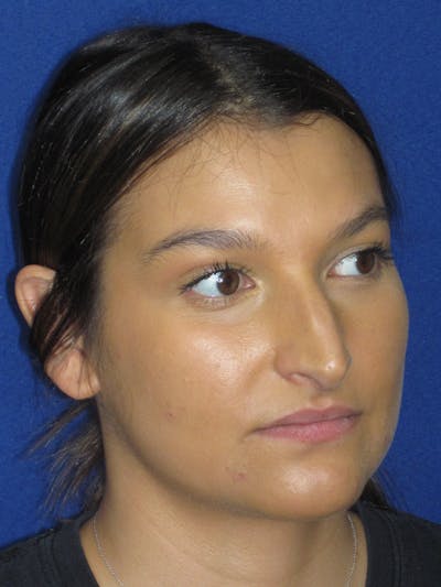Rhinoplasty Before & After Gallery - Patient 335222 - Image 1