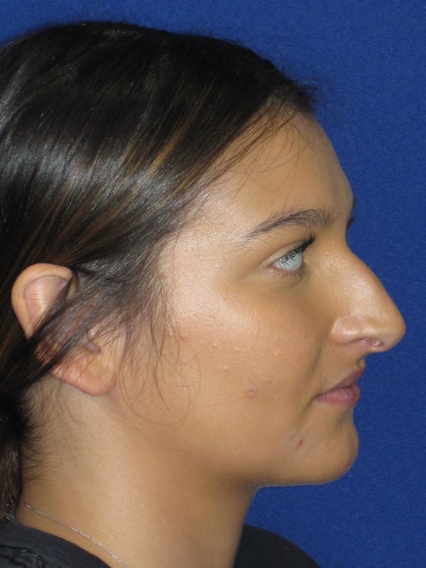 Rhinoplasty Before & After Gallery - Patient 335222 - Image 5