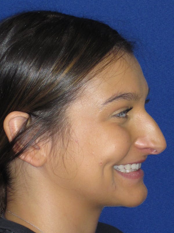 Rhinoplasty Before & After Gallery - Patient 335222 - Image 7